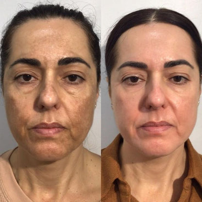 SeoulGlow™- 4% Retinal Liposome Facial Treatment