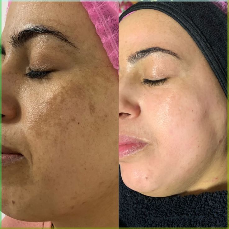 SeoulGlow™- 4% Retinal Liposome Facial Treatment