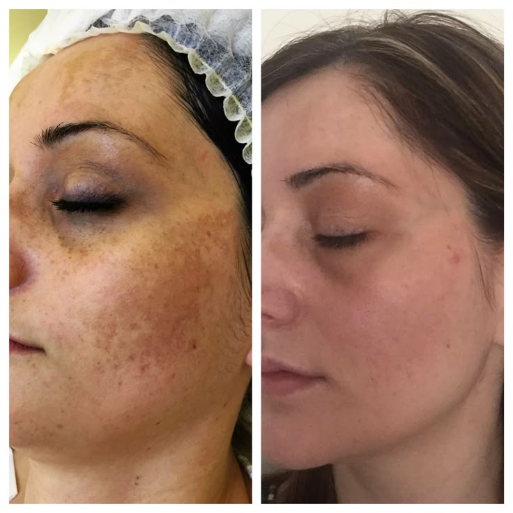 SeoulGlow™- 4% Retinal Liposome Facial Treatment